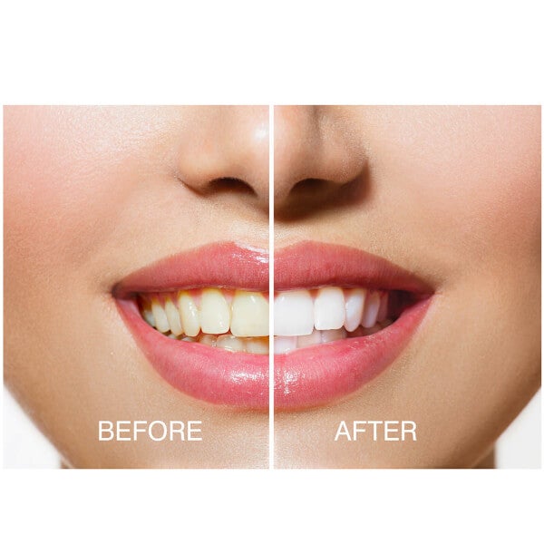 Rio Rio Smile White Advanced Teeth Whitening Kit Comprane uno, ottenene uno gratis