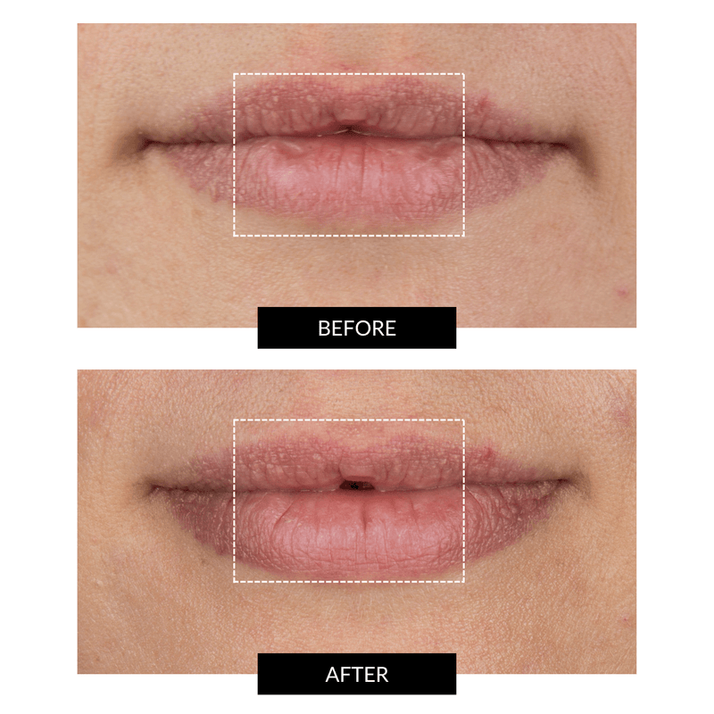 CurrentBody Skin LED Lip Perfector Nuovo