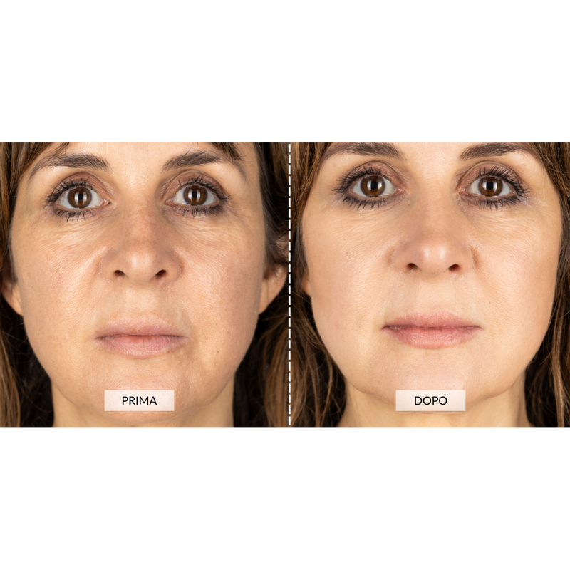 CurrentBody Skin Dispositivo a radiofrequenza per il viso RF Currentbody Skin Vendita