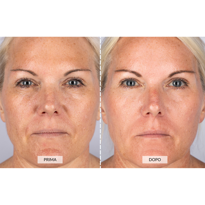 CurrentBody Skin Dispositivo a radiofrequenza per il viso RF Currentbody Skin Vendita