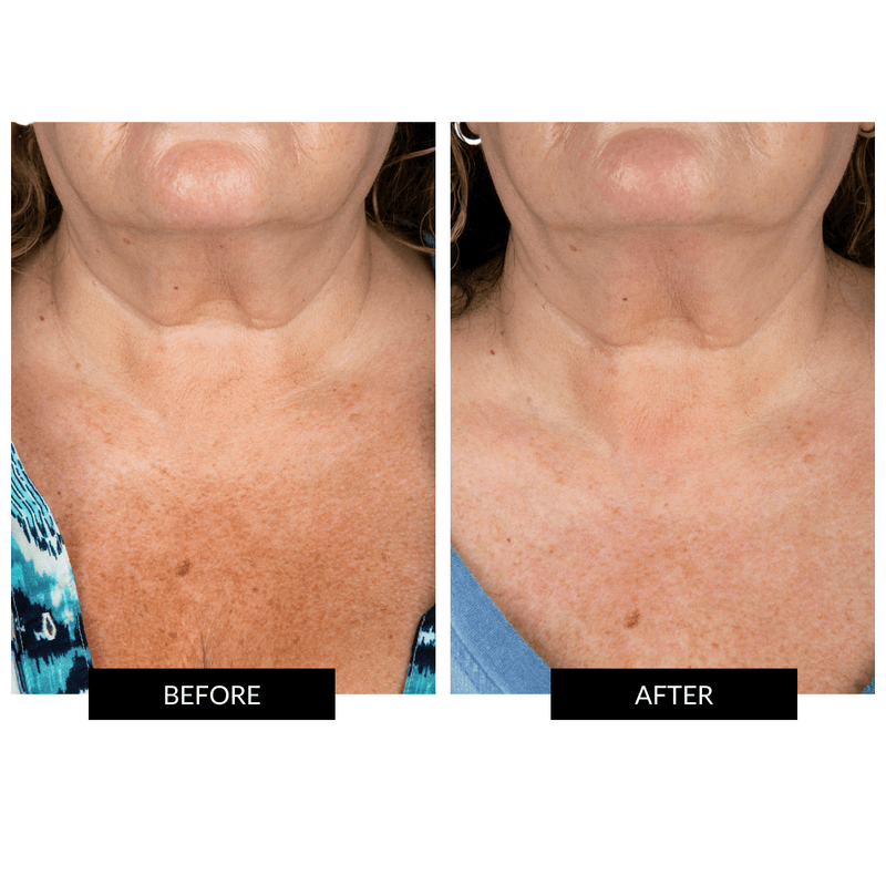 CurrentBody Skin Maschera Collo e Décolleté Promozione Limitata
