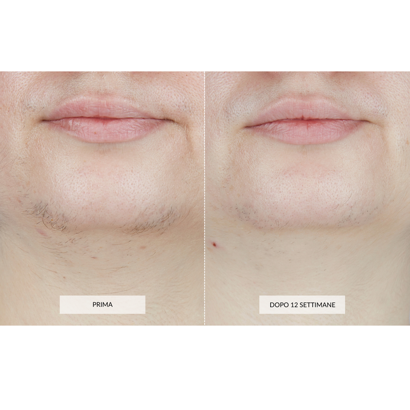 CurrentBody Skin Dispositivo di Epilazione Laser Prezzo Ridotto