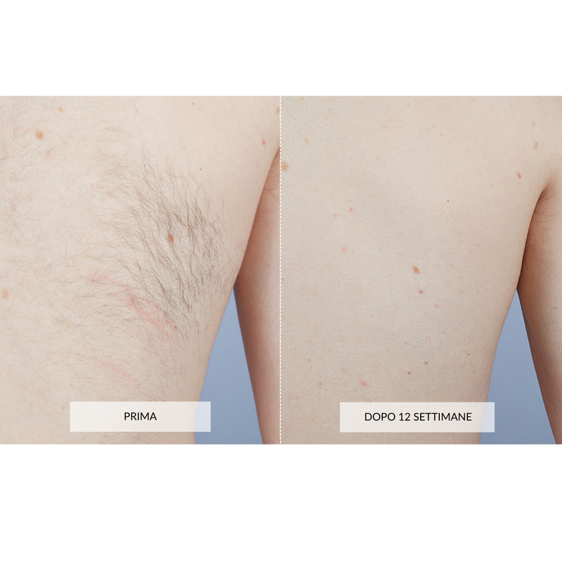 CurrentBody Skin Dispositivo di Epilazione Laser Prezzo Ridotto