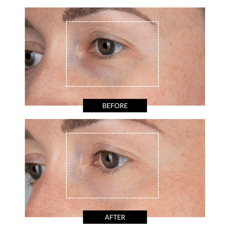 CurrentBody Skin LED Eye Perfector & 5 Eye Hydrogel Masks (del valore di 249€) Vendita Calda