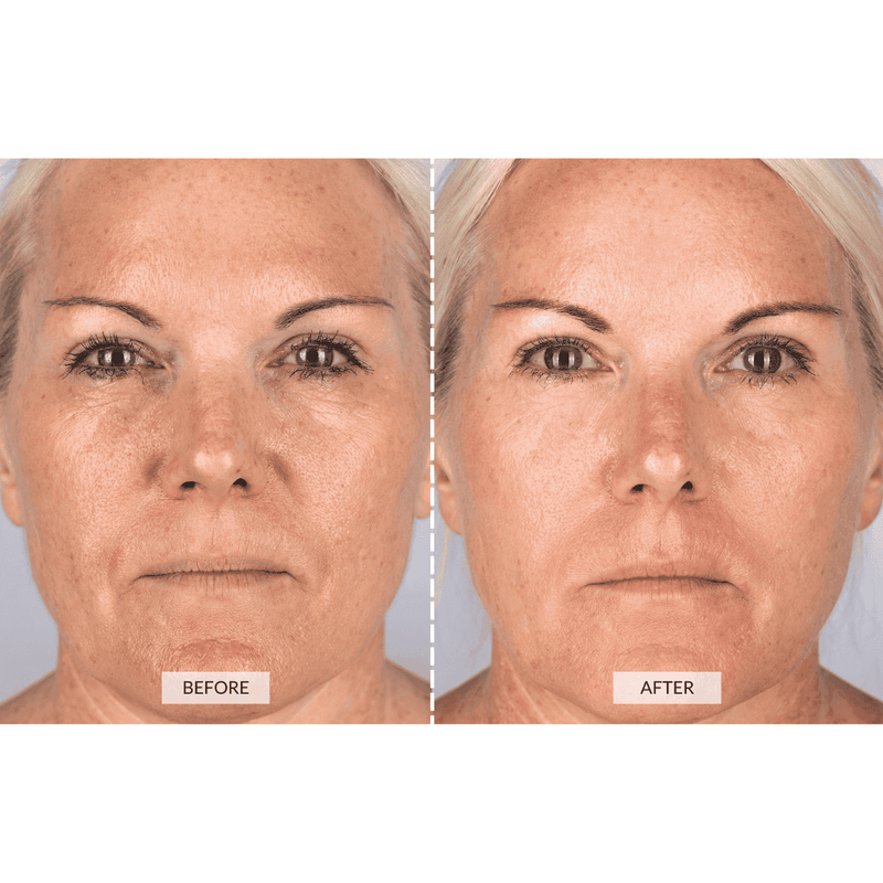 CurrentBody Skin Dispositivo a radiofrequenza RF x Sonia Sélaire Vendita