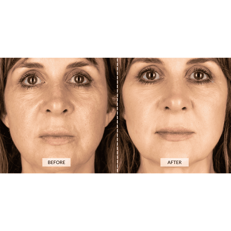 CurrentBody Skin Dispositivo a radiofrequenza RF x Sonia Sélaire Vendita